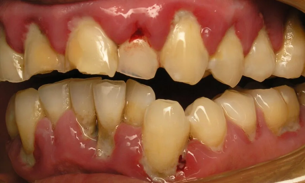 plaque and tartar on teeth
