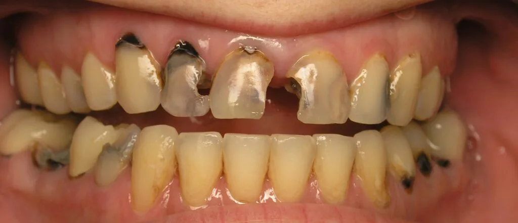 Dental Anxiety and Oral Health Anxious dental patient during their first visit