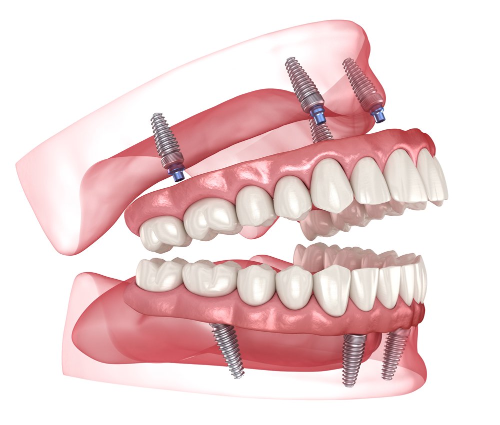 Dental Implants in San Marcos, CA dental prosthesis based on 4 implants. dental 3d illustration