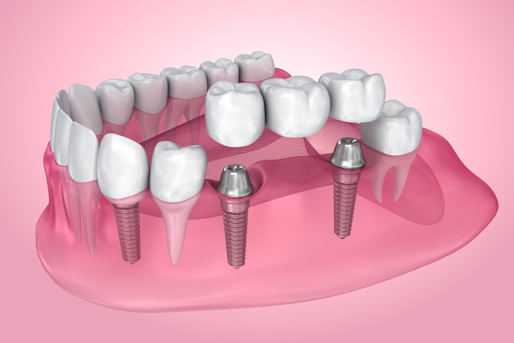 implant bridge implant bridge