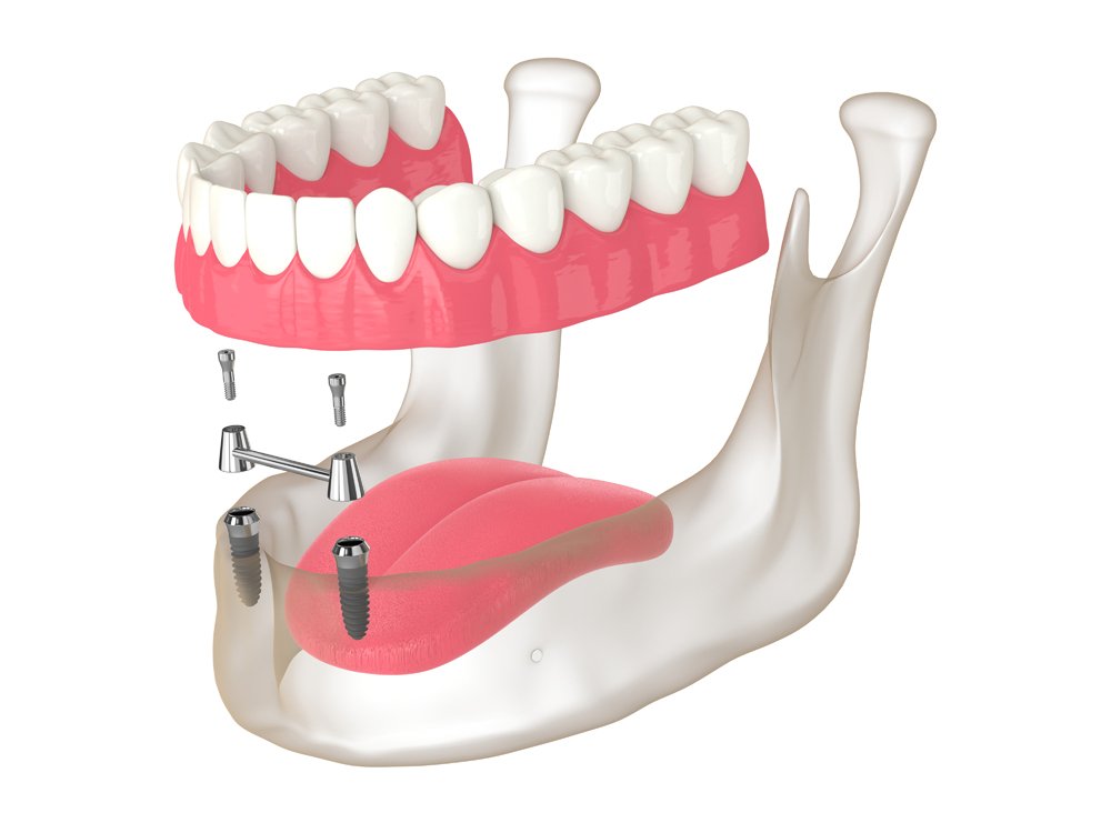 implant dentures 3d render of removable overdenture installation on bar clip atta