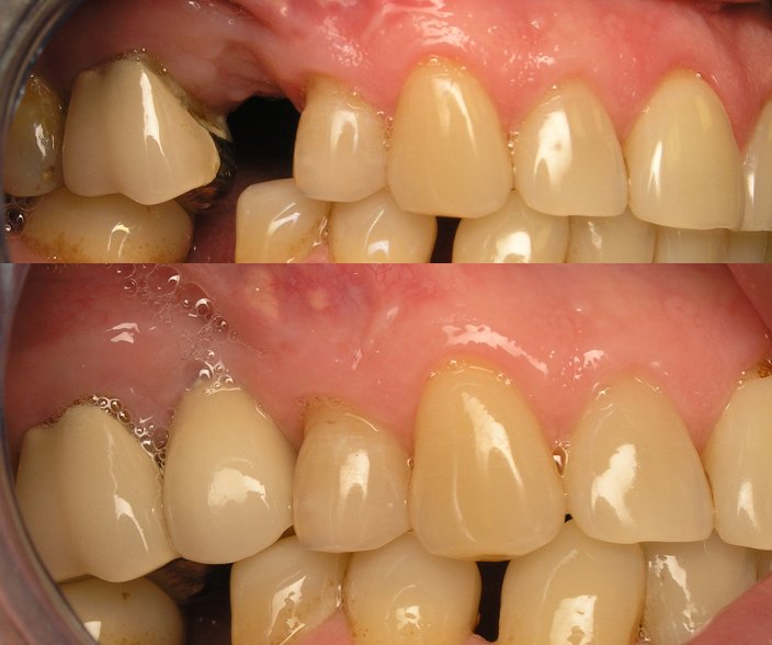 Dental Implants - San Marcos Implant Dentist single implant before after